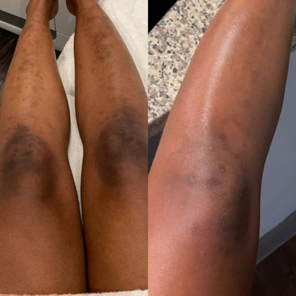 Dark Skin Bleach Body Bleaching Cream Max Strength Whitening Lightening - Picture 10 of 12